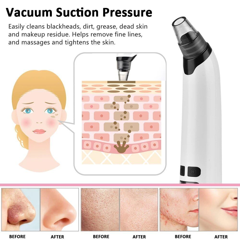 Electric Blackhead Remover Vacuum with Adjustable Suction