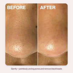 Ultrasonic 2-in-1 Pore Extractor & Skincare Infuser